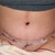 Post Tummy Tuck - Day 5
