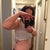 Side view 8 weeks post FTT