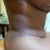 scar from side