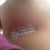 Day 5 incision