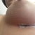 Day 5 incision, and the wonderful ridges from my compression bra... I can't wait to get rid of that thing!