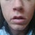AFTER (wide nostrils and thick flesh between nose & lip)