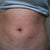Small bruises on lower abs 8 days after procedure