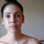 6 months post op