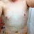 Day 5 Post Op - Still some swelling but I look completely different then I did prior to getting it.