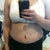 13 days PO, still swollen