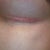 Left incision right after tapes being removed 11 days post op.