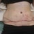 Day 2 Post Op!