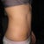 11 weeks post op