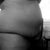 1 week tummy tuck, liposuction pre op