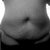 Front 1 week tummy tuck, liposuction pre op......This is really horrible..