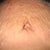 I know I still have some swelling causing the marks to puff out, but once that dissipates it will just be even more wrinkly.  So fugly.