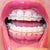 I have worries over my lower gum-line receding!  The braces are also pulling my teeth up from the socket.  If this is a serious issue then I must do something.  Otherwise my gums seems healthy.