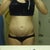 1 month post operation(some looseness in skin remains, but did not make sense to have a full-tummy tuck pre babies)

PM Photo
