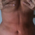 Two Weeks Post OP