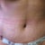 Sorry it's not clearer. But this is 3 days PO. Got some swelling going on but looks pretty good!