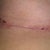 Quick snapshot of scar under breast. Been rubbing cocoa butter and arnica gel twice a day to help with swelling...