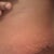Closeup of the right side of the scar (day 8 PO)