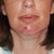 First day post op. I look like a chipmunk!