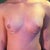 3 days post-op, 175cc moderates, under, silicone