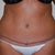 Physicians after pic 4 months post op...not happy about that scar!!