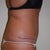 4 months post op physicians pic