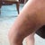 still so bruised day 6 post op