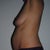 Left side (night before surgery)
36 DD breasts