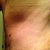 POST OP DAY 8