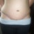 One month post op front