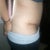 One month post op side... still lots of swelling