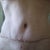 6 wks post op  shows a stitch that will hopefully work itself out soon or PS will remove it in 2 1/2 weeks.  Still oozes a tad bit