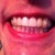 I just put 28/35 upper and 28/30 lower on now. I'll take another one soon without the aligners in.