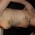 six days post op
