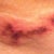 immediately after 4th treatment