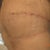 9 days post op