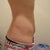 Still have bump on right side
