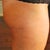 close up right lateral top of thigh