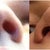 Uneven nostrils - before (left) vs. after surgery (right)