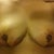 3 days Post-Op