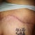 Right side i used Mederma an look at my scar.I love the way my scar looks with me use n Mederma