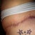 Ok now this is how my lft side looks with me use n Silicone strips..I am very disappointed ion outcome..i used for 2months and it spread out scar...