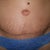 3 weeks post op - tummy tuck close up