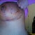 day 8 righty still bruised but better