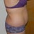 Before- Side View