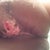 Oct 9th (saw Dr. Mountcastle today) I popped up at his office and he seemed shocked. He looked at this and said "your going to lose more skin" He covered it and sent me home.