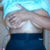 front view 2 days post op and almost standing upright