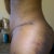 side view 11 days post swelling and bruising from Lipo is getting better.