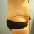 5 days post-op