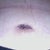 belly button close 2 weeks after surgery